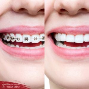 Results of Invisible Braces 
