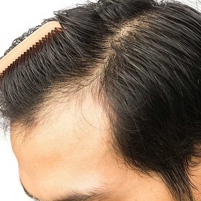 How to Take Care of Transplanted Hair