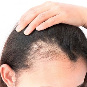 Infections that Cause Hair Loss