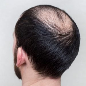 Treatment of Alopecia through PRP Treatment