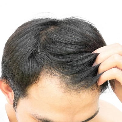 Ways to increase hair growth after hair transplant