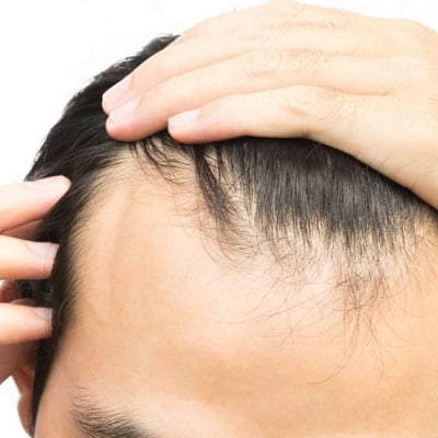 Why choose hair transplant in Pakistan