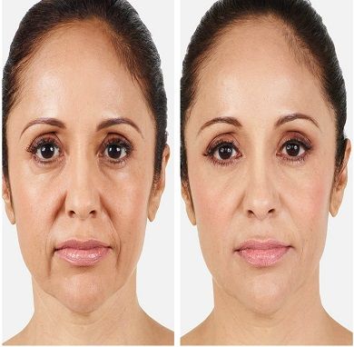 juvederm volatile fillers in Islamabad Rawalpindi & Pakistan