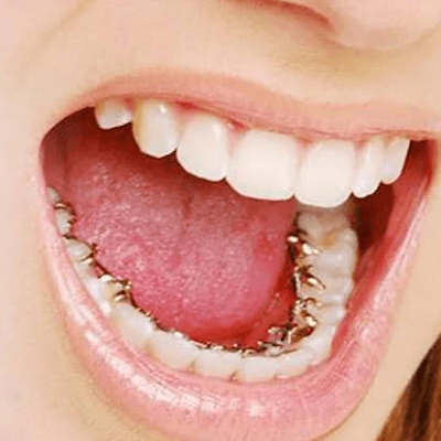 Invisible Braces Cost in Islamabad