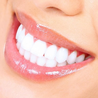 Teeth Whitening Cost in Islamabad