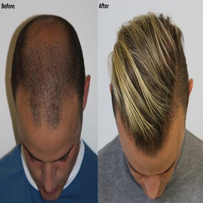 crown hair transplant in Islamabad