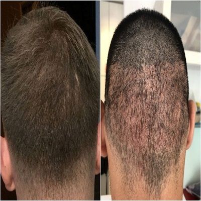 scarless Hair Transplant in Islamabad