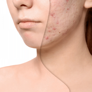 Acne Scars Treatment Cost in Islamabad Pakistan