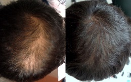 PRP Hair Treatment cost in Islamabad