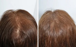 PRP Hair Treatment Islamabad