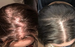 PRP Hair Treatment