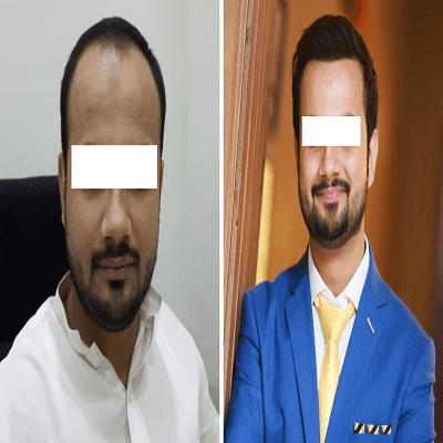 Male Hair transplant in Islamabad, Rawalpindi & Pakistan