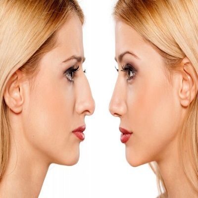 nose tip plasty in Islamabad, Rawalpindi & Pakistan