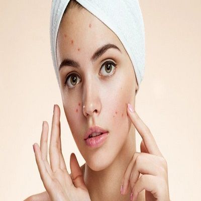 pimple treatment in Islamabad Pakistan