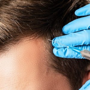 Benefits of PRP Treatment in Pakistan