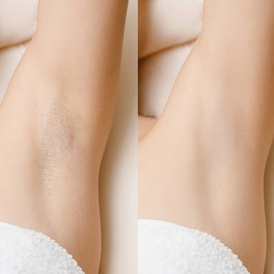 Underarm Laser Hair Removal in Islamabad Pakistan