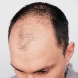 Latest FUE Hair Transplant Techniques Islamabad Pakistan