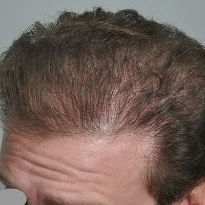 Long Term and Short Term Side Effects of Hair Transplant Surgery