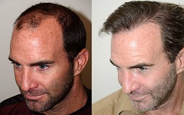 Hair Transplant cost in Islamabad