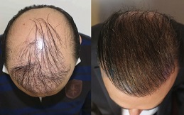 Hair Transplant in Islamabad