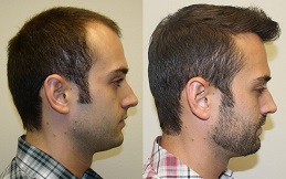 Hair Transplant price in Islamabad