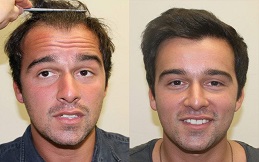 Hair Transplant result in Islamabad