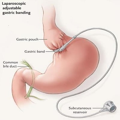 Benefits of Bariatric Surgery in Islamabad Pakistan