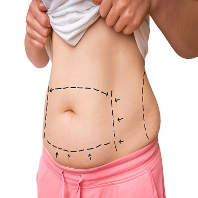 Liposuction Cost in Islamabad