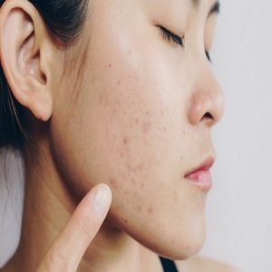 Subcision Treatment for Acne Scars in Islamabad