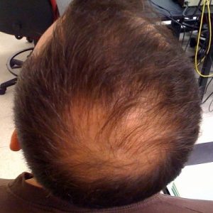 All You Need To Know About Hereditary Hair Loss