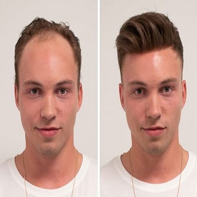 Hair Transplant for Receding Hairline in Islamabad