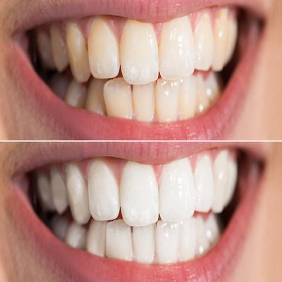 How Does Laser Teeth Whitening Work in Islamabad