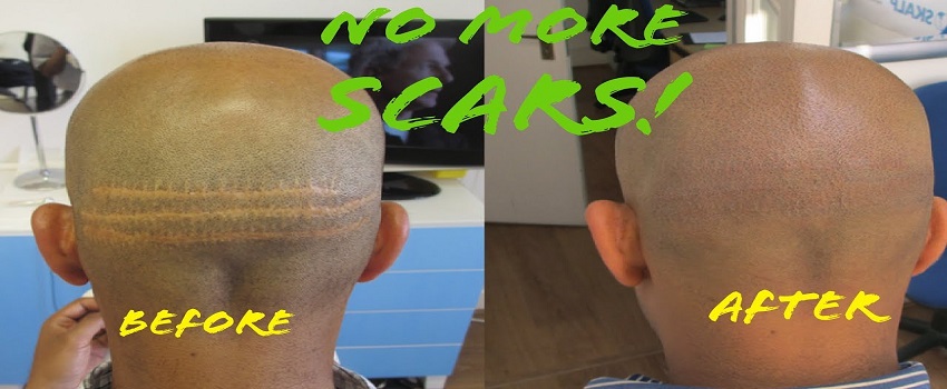 How To Get Rid of Hair Transplant Scars in Islamabad Pakistan