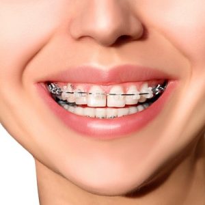 Dental Braces Cost in Islamabad