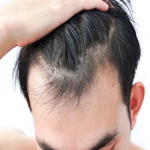 What Is The Right Time To Get a Hair Transplant in Islamabad