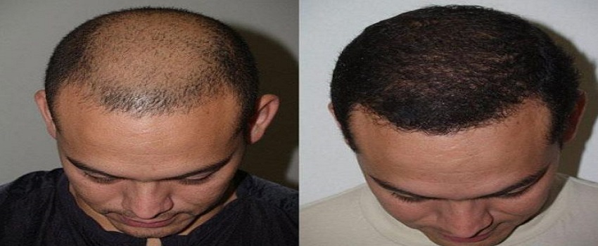 Which is the best Hair Transplant in Pakistan