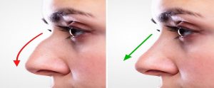 Best Rhinoplasty Clinic in Islamabad