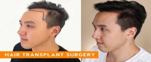 Hair Transplant Side Effects in Islamabad