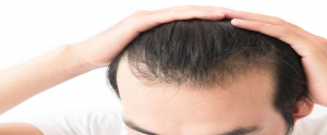 Hybrid Hair Transplant in Islamabad