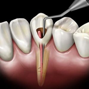 Best Dental Clinic in Islamabad For Root Canal Treatment
