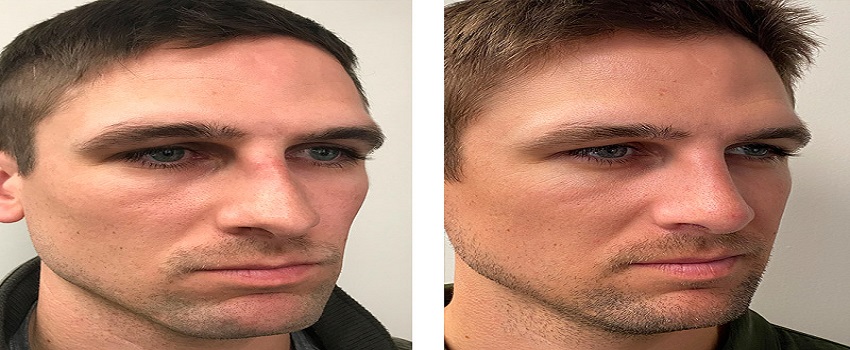 Can Rhinoplasty Give You Desired Nose Shape