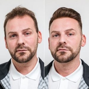 Hair Regrowth Stages After a Hair Transplant