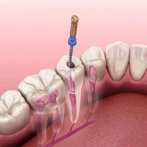 Root Canal Treatment Cost in Islamabad