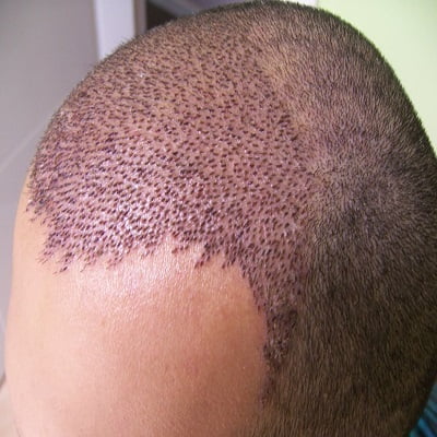 Why Does Shock Loss Occur After Hair Transplant