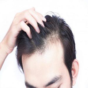 Why Hair Transplant Is Recommended for Curing Hair Loss
