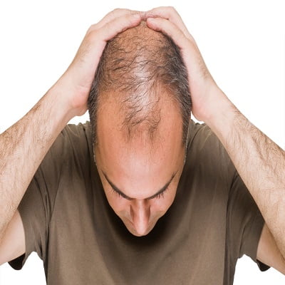 Would a Hair Transplant Help You to Get Promoted