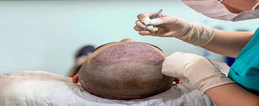 Beware of Black Market Hair Transplant And Illicit Clinics