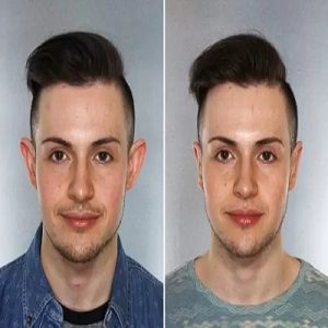 A Brief Guide to Otoplasty Surergy in Islamabad