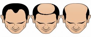 Does an Uneven Hairline Mean That You Are Balding?