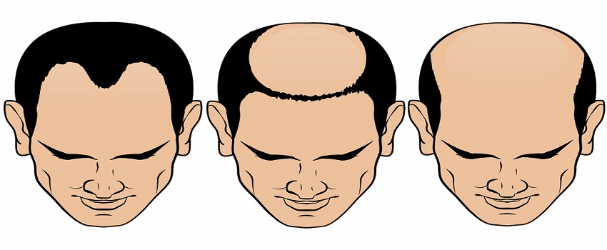 Does an Uneven Hairline Mean That You Are Balding